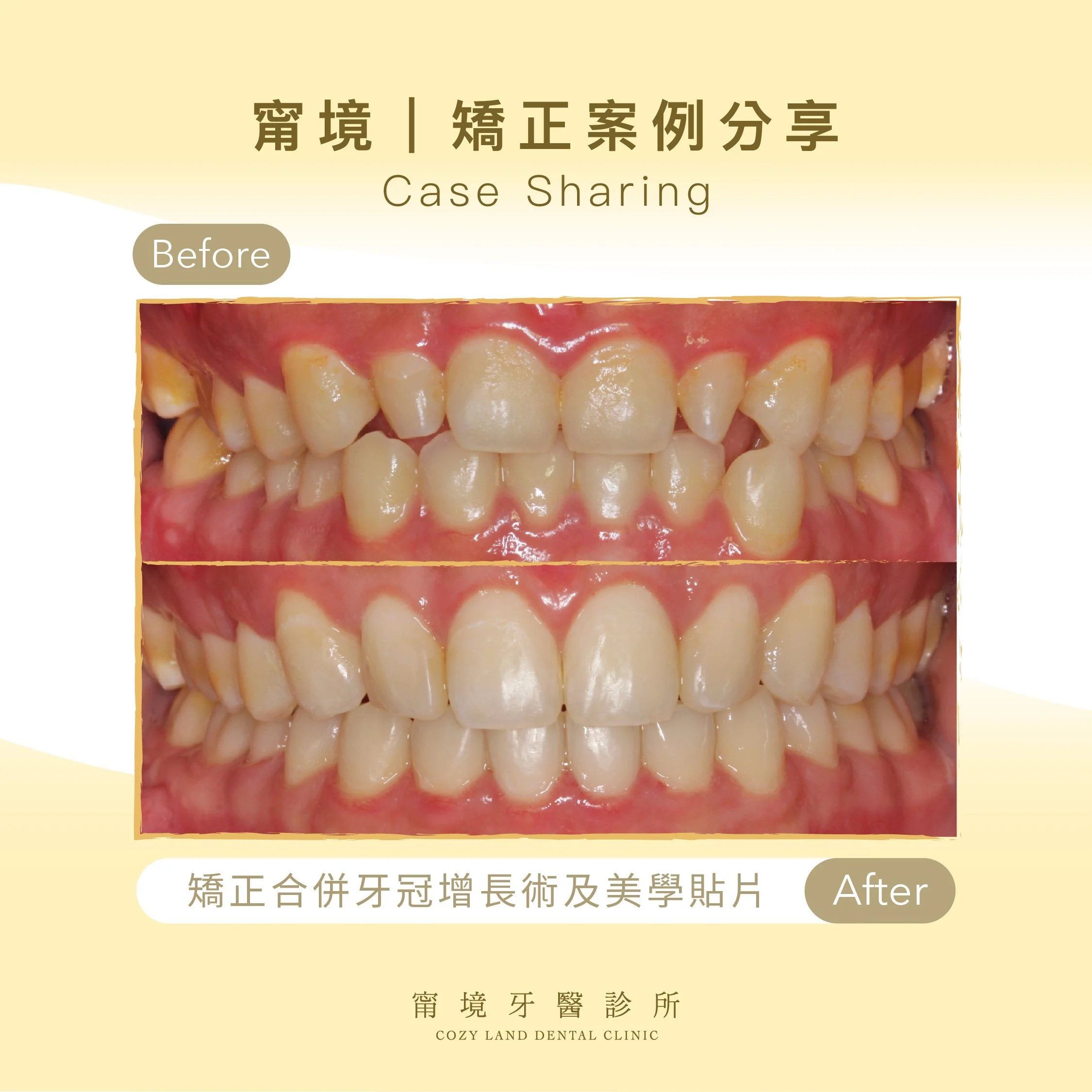 甯境牙醫成人矯正案例縮圖｜矯正結合牙冠增長術美學貼片整合治療前後