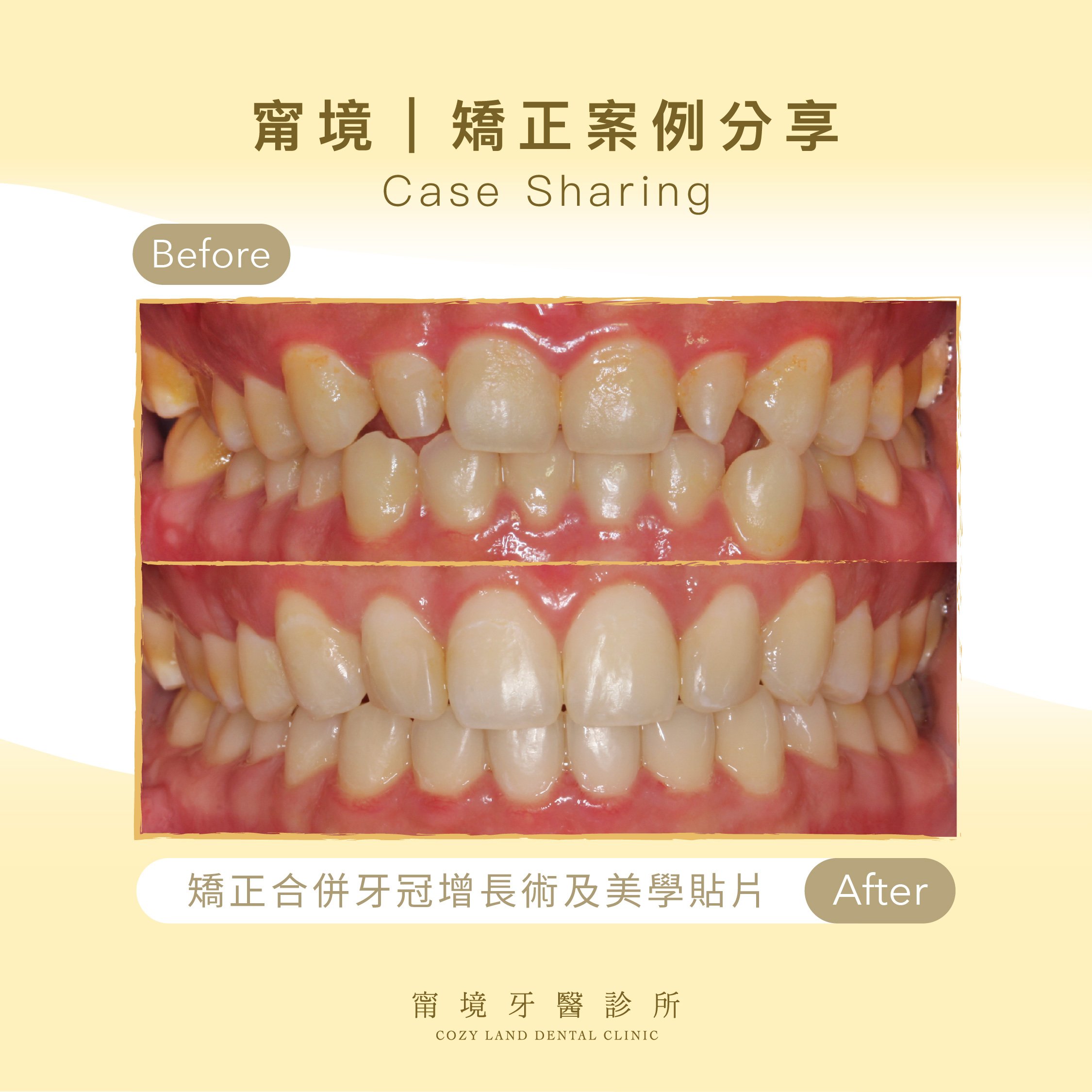 甯境牙醫成人矯正結合牙冠增長術整合美學案例圖｜側門牙釘狀齒矯正前後成果