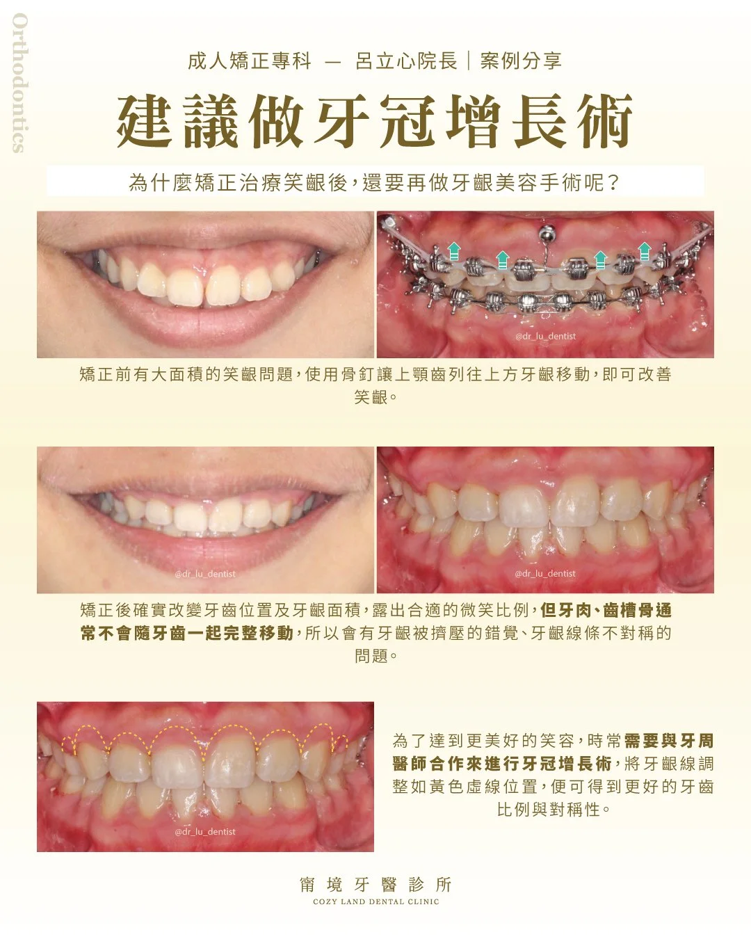 甯境牙醫矯正後牙齦美觀改善照｜建議搭配牙冠增長術調整牙齦線條，讓笑容更完美