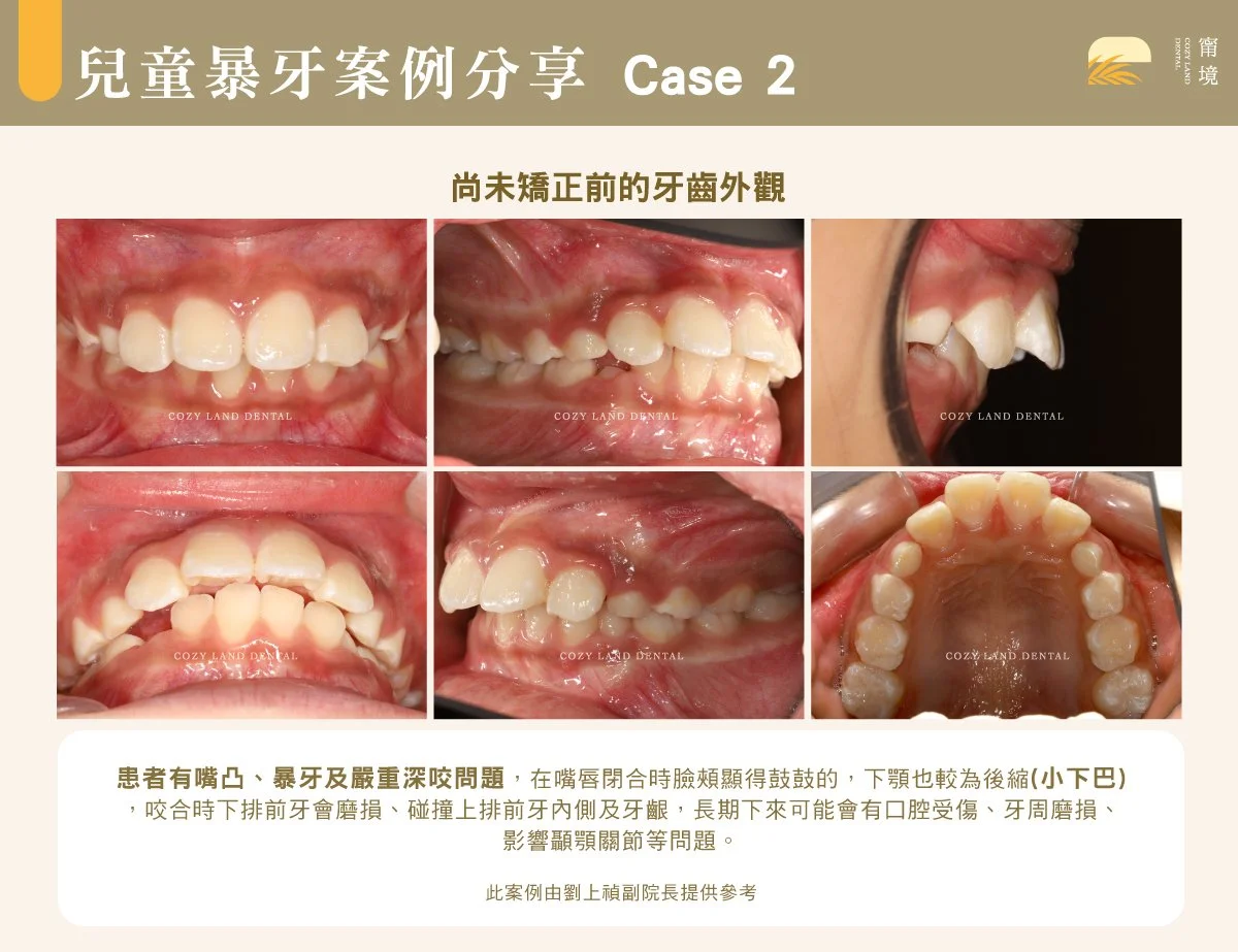 兒童暴牙不良習慣成因說明圖｜頂舌、吸奶嘴、吸手指等後天因素