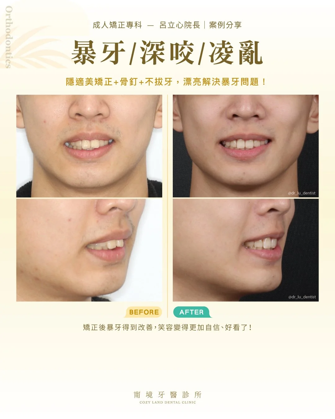 咬合不正對臉型的6種影響圖｜臉型不對稱、下巴後縮等影響示意