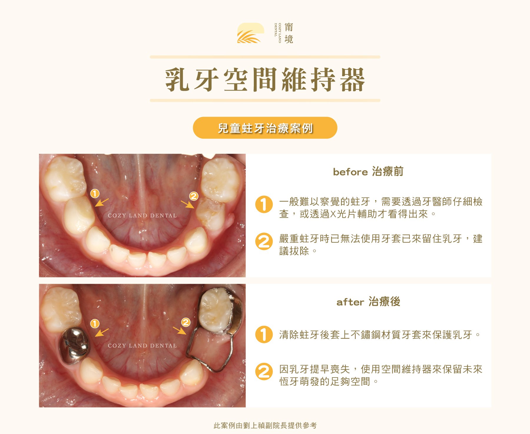 乳牙牙套 4 步驟療程圖解｜清除蛀牙、消毒、修整、套上牙套完整流程說明
