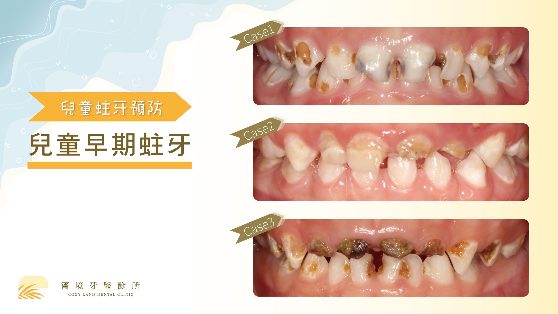 兒童牙齒保健衛教資訊圖｜塗氟原理與防蛀功效說明