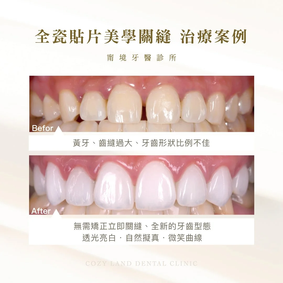 甯境牙醫全瓷貼片美學關縫治療前後對比圖｜不需矯正關閉門牙齒縫，改善牙齒大小不一