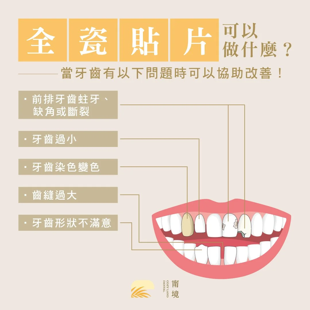 全瓷貼片美白效果展示圖｜前牙色澤改善與自然光澤對比，黃裕新醫師案例