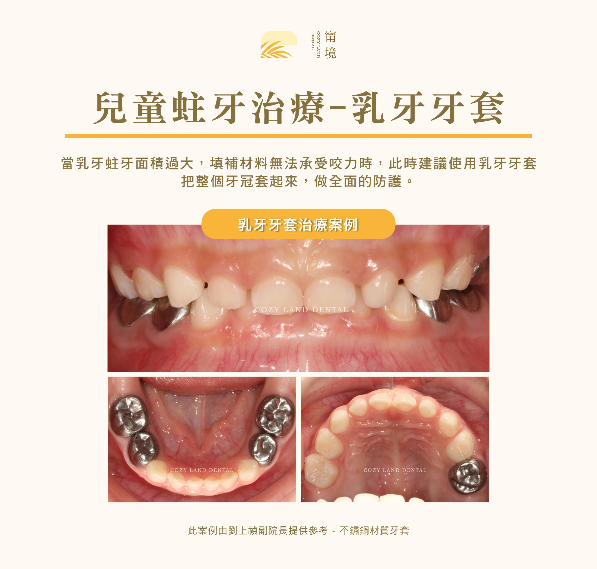 兒童乳牙牙套（小鋼牙）介紹說明圖｜乳牙蛀牙時何時需要裝牙套的判斷標準