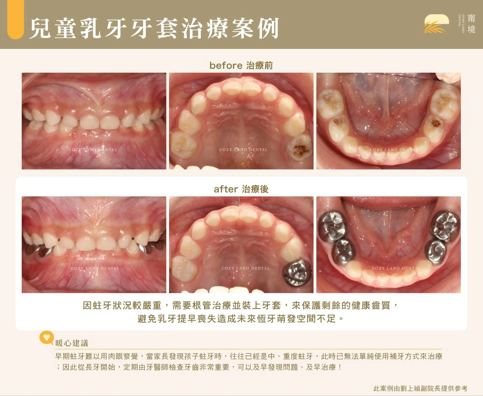 兒童乳牙牙套不適合情況說明圖｜乳牙牙根吸收超半或即將換牙不適合裝牙套