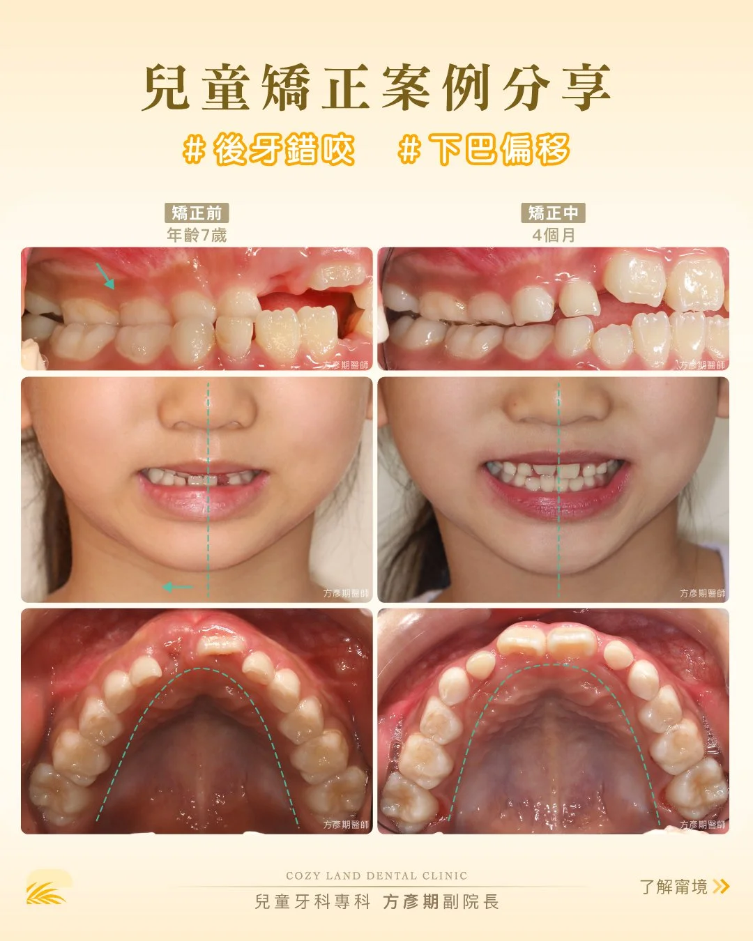 甯境牙醫兒童矯正後照片｜固定式上顎擴張器治療 4 個月後咬合改善、笑容對稱（方彥期副院長）