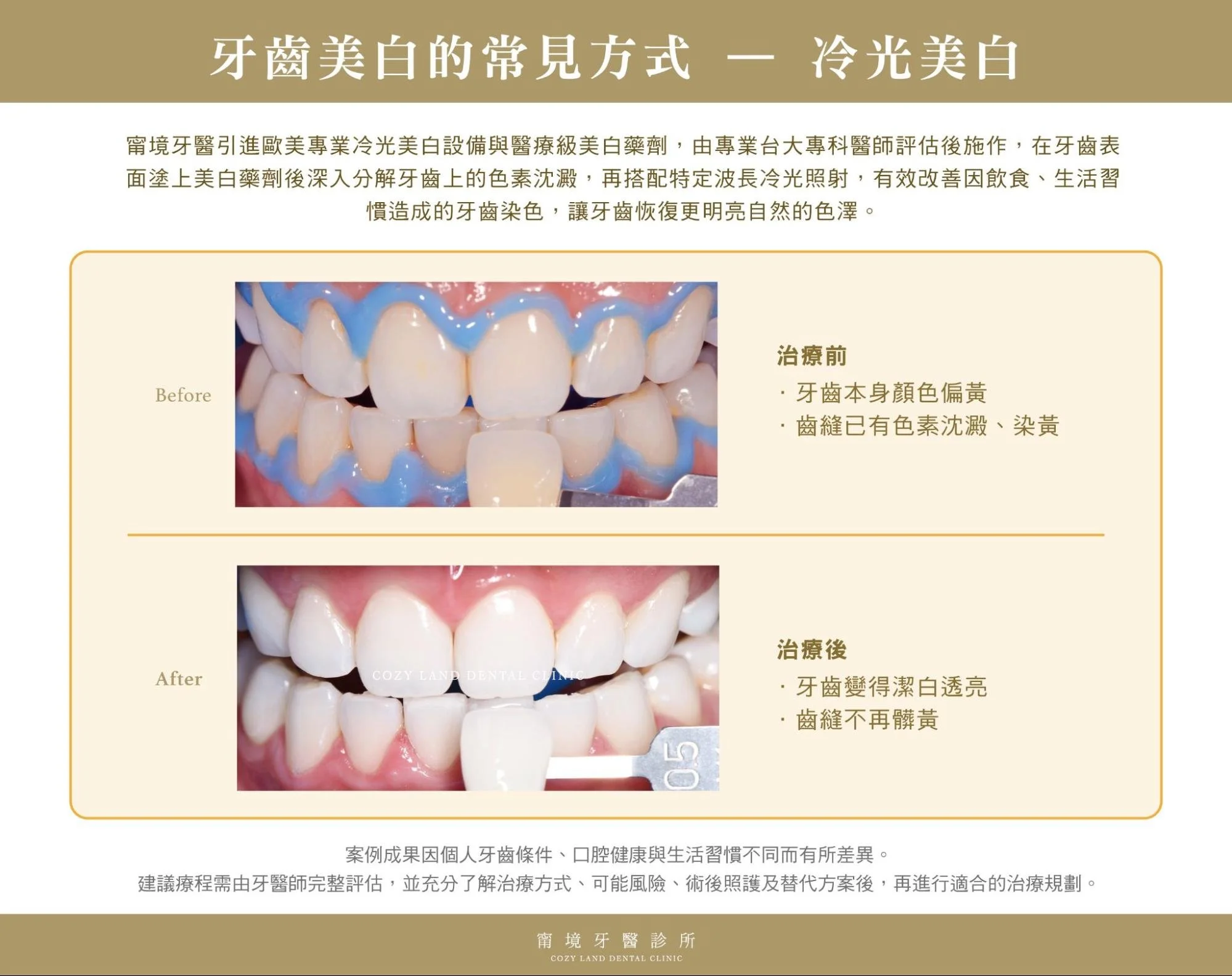 牙齒美白：冷光美白