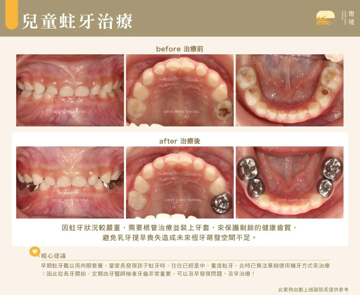 兒童嚴重蛀牙