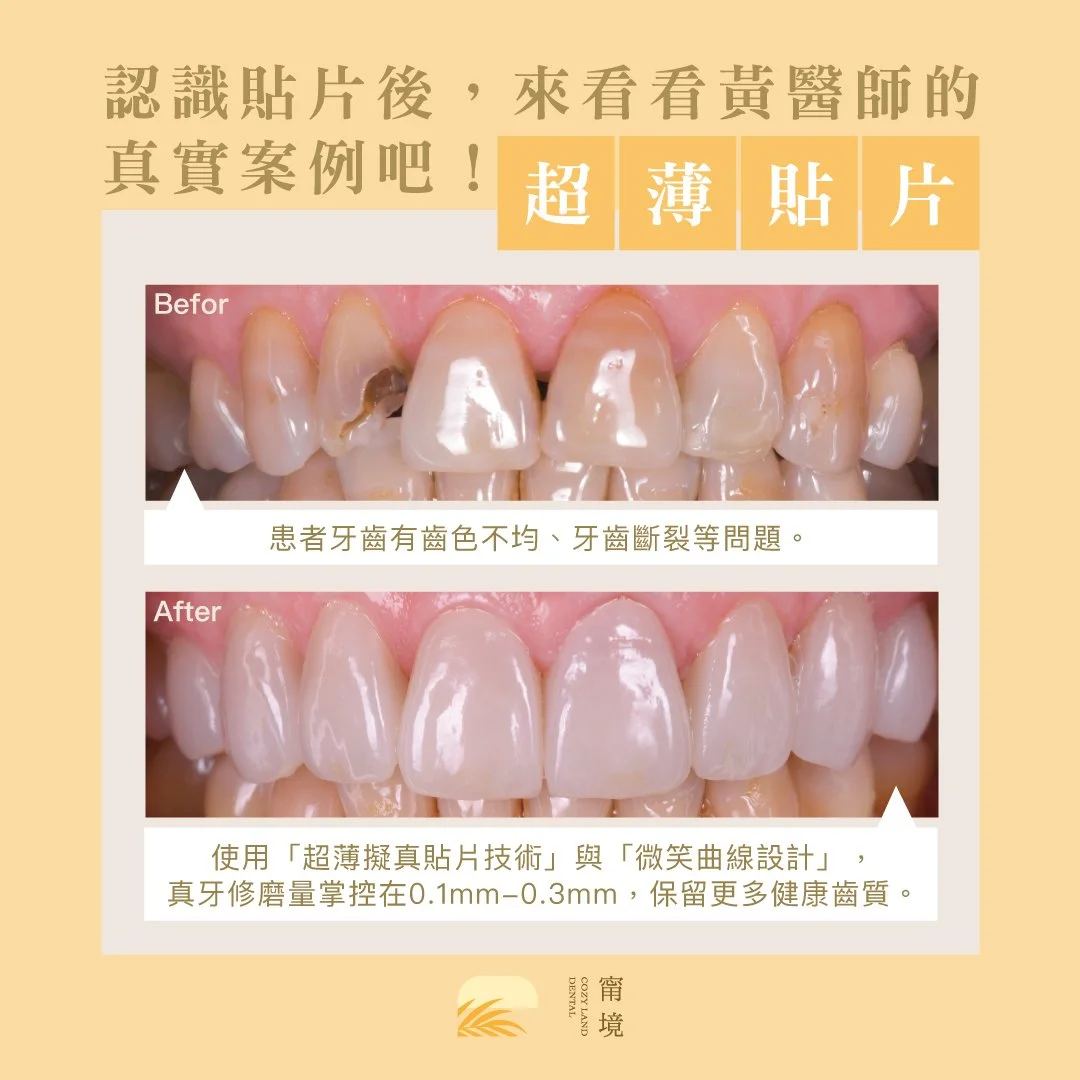 全瓷貼片案例 1 前後對比｜解決齒色不均牙齒斷裂，超薄陶瓷貼片修復成果