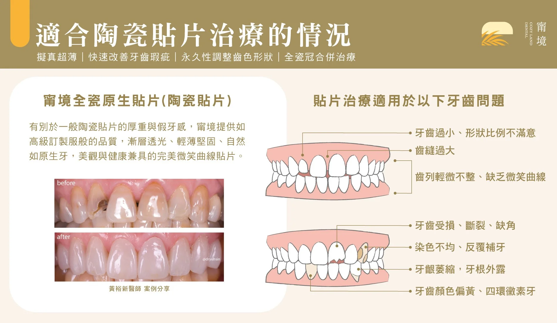 必須矯正的4種情況說明圖｜深咬、地包天、嚴重擁擠、開咬評估標準