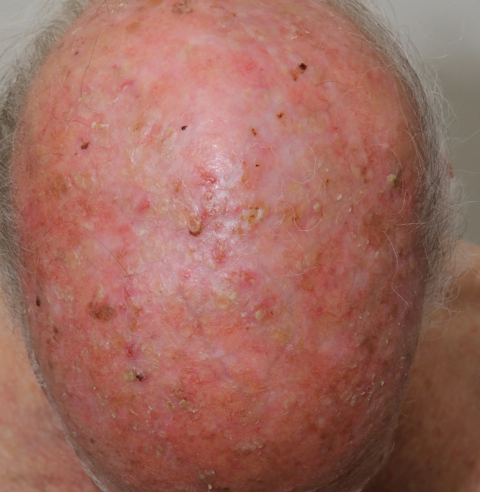 skin-cancer-skintel