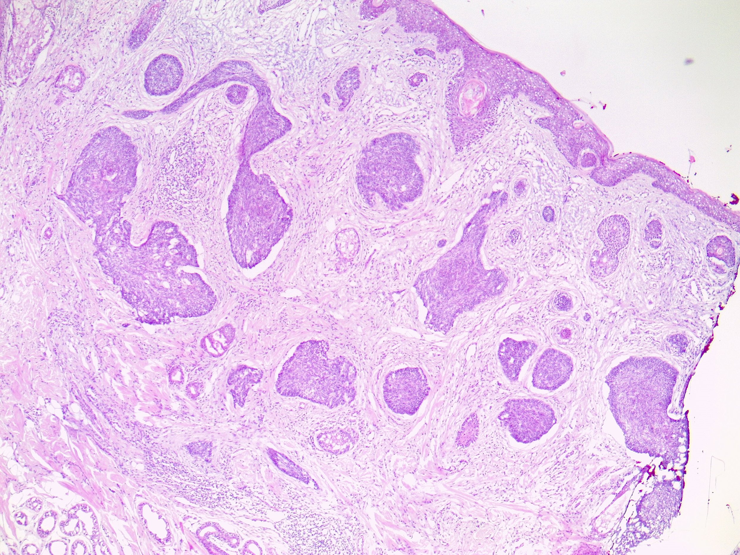 Basal cell carcinoma: The Definitive Guide Skintel Basal cell carcinoma: The Definitive Guide Skintel