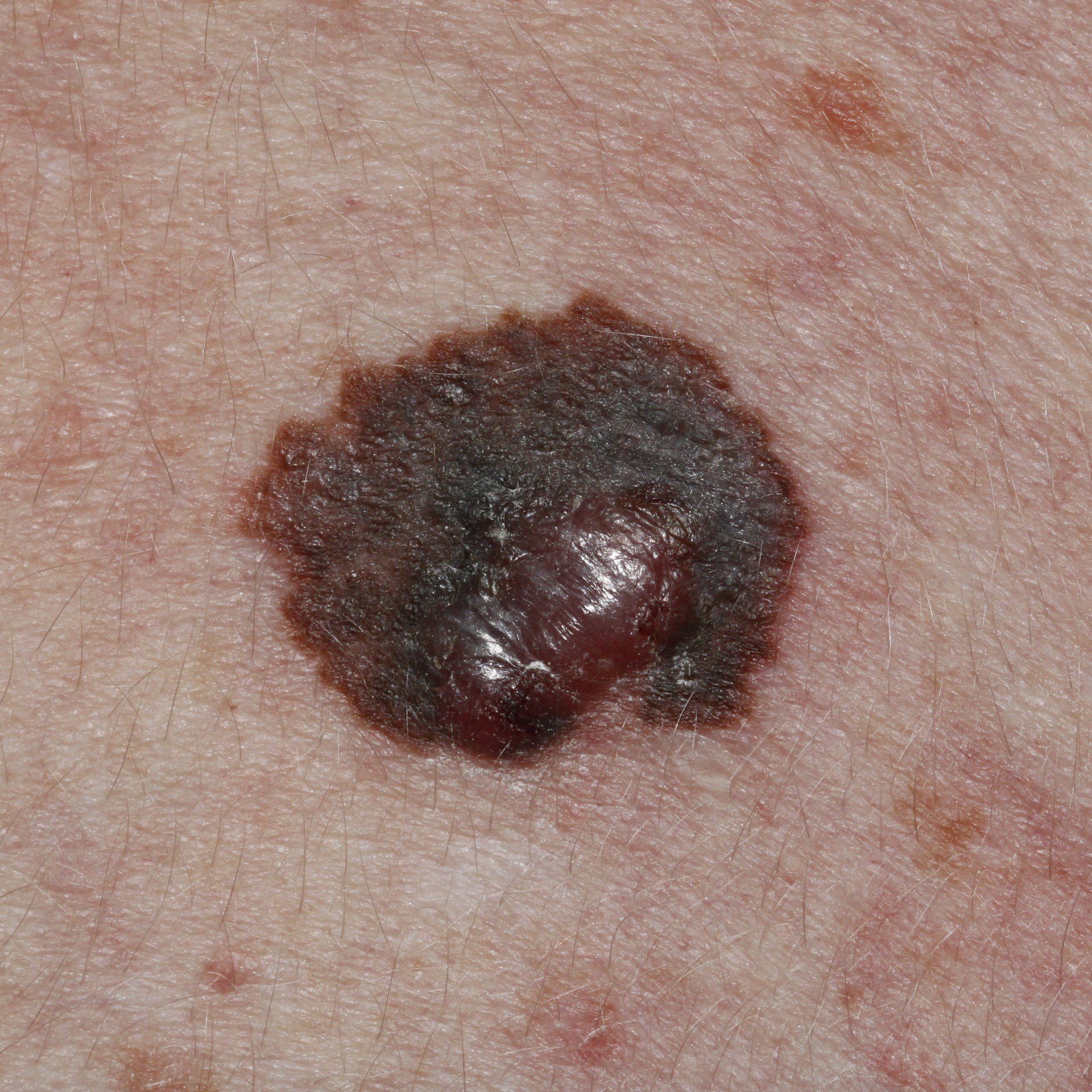 superficial spreading malignant melanoma
