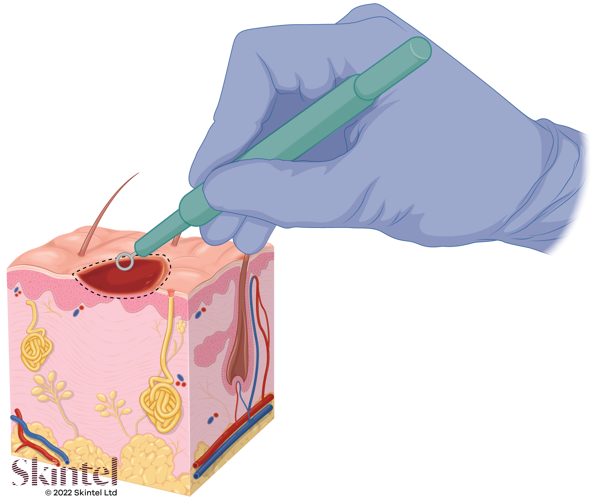 Basal cell carcinoma The Definitive Guide Skintel