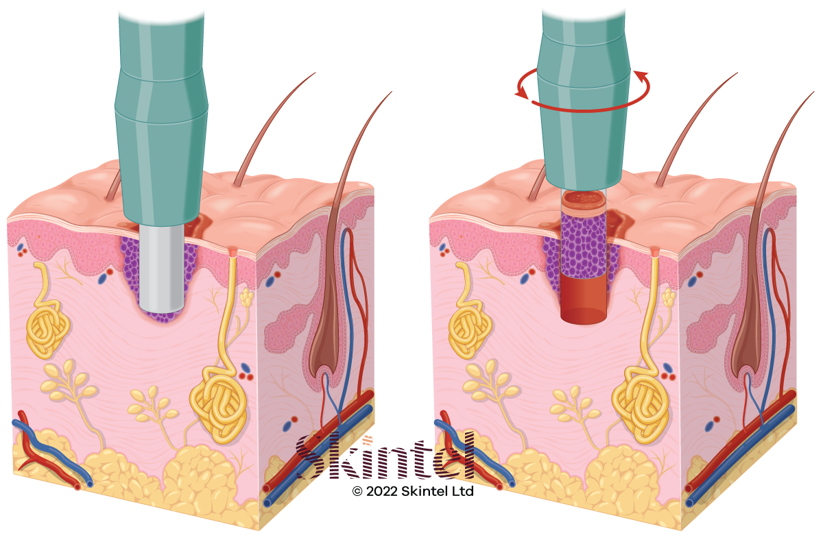 Skin Biopsy Punch Biopsy More Auckland NZ Skintel skin-biopsy-punch-biopsy-more-auckland-nz-skintel