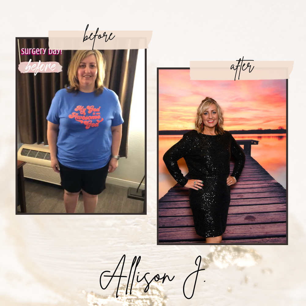 Dr Bruces before and after Bariatric surgery and weight loss patient