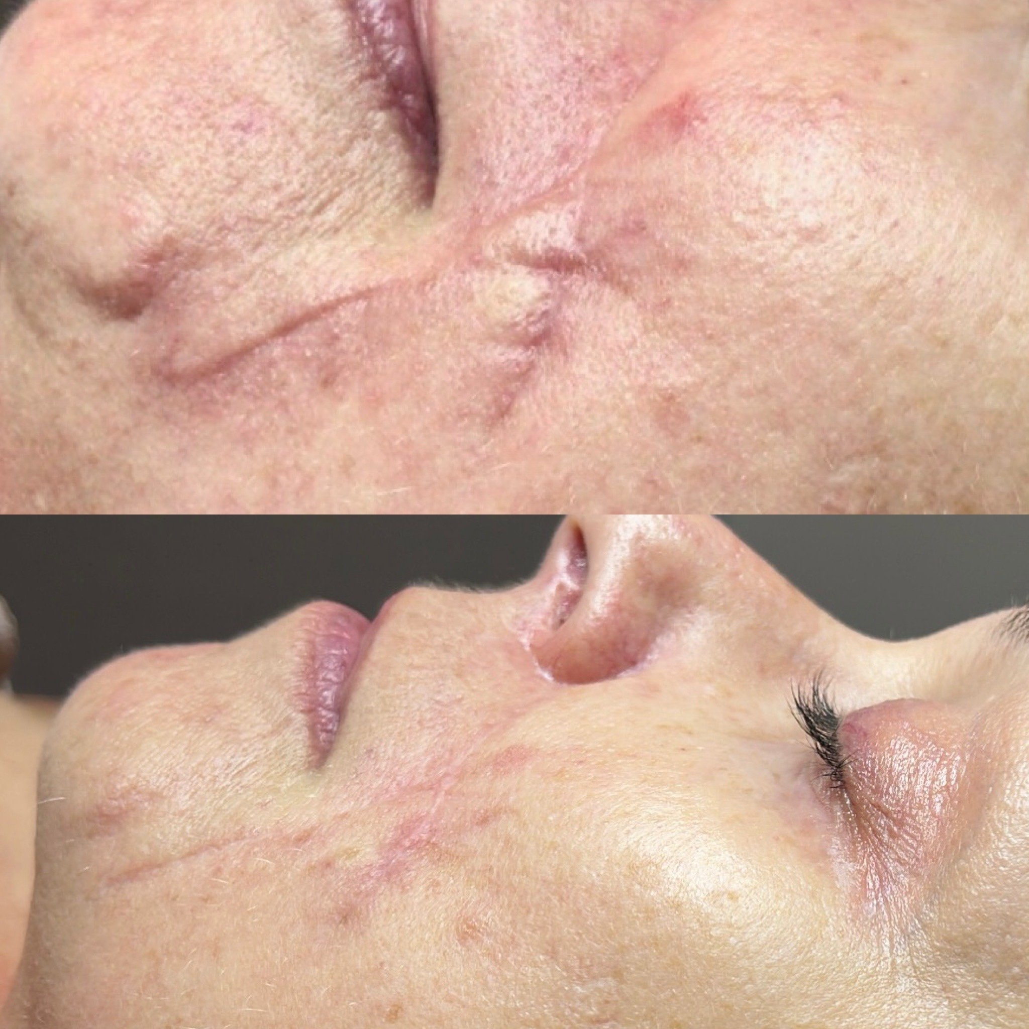 Scar revision at SELF_