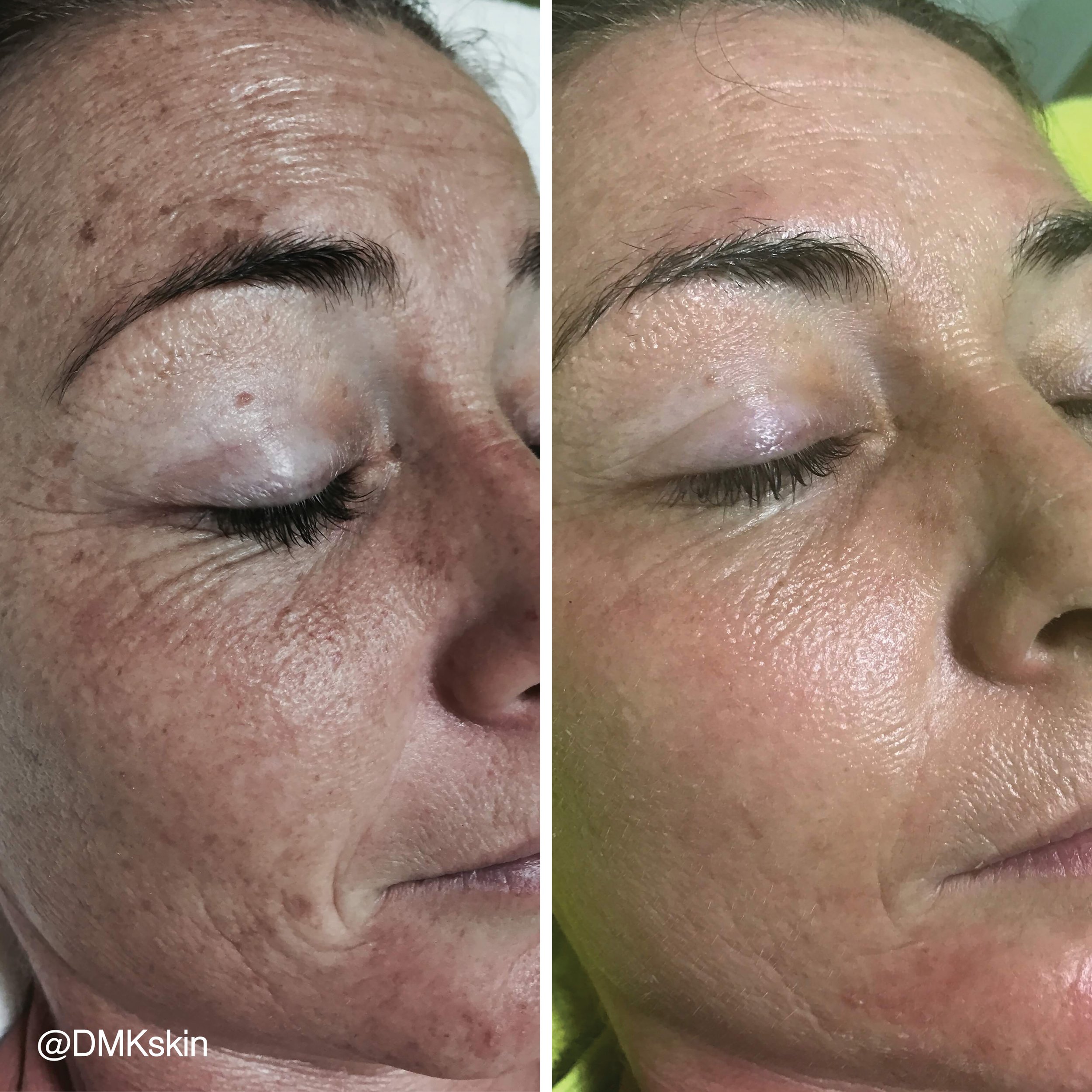Stress and your skin