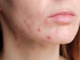 Do you have lumpy bumpy skin?