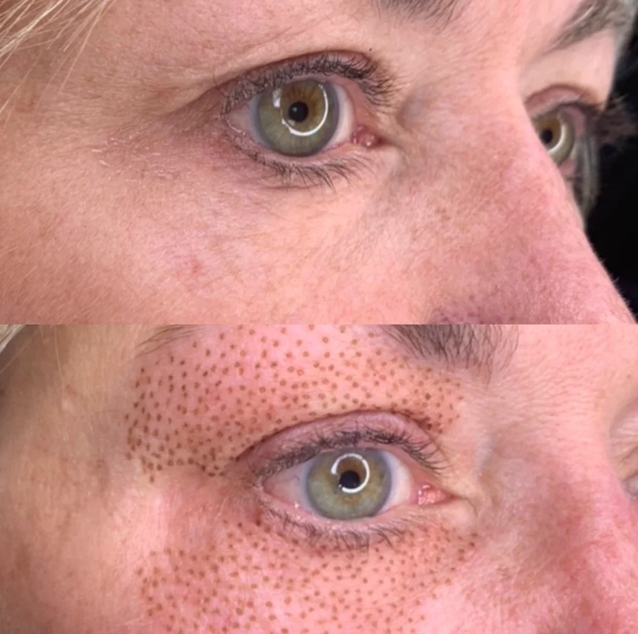 Before and after fibroblast treatment