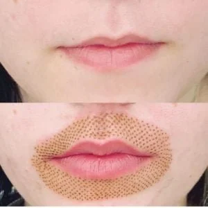 Upper and Lower Lip Flip - before and after fibroblast treatment