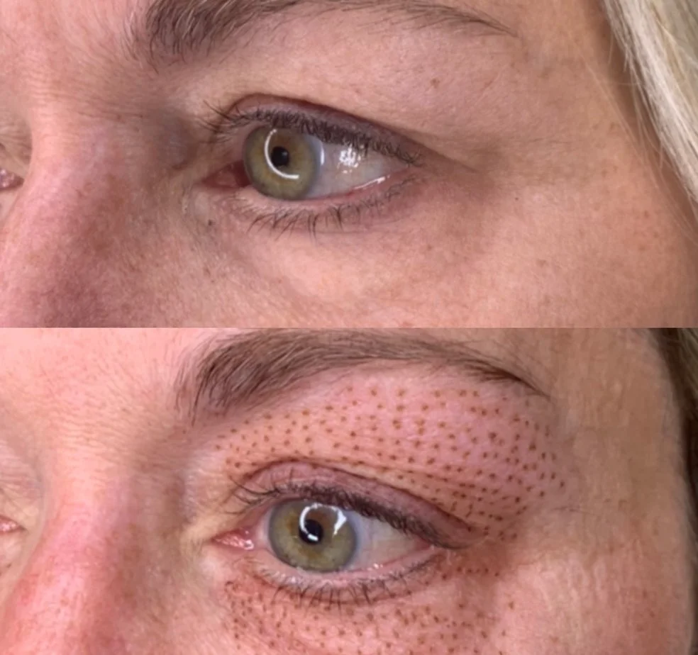 Before and after fibroblast treatment