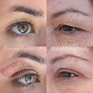 Left: fibroblast procedure   Right: Blepharoplasty surgery