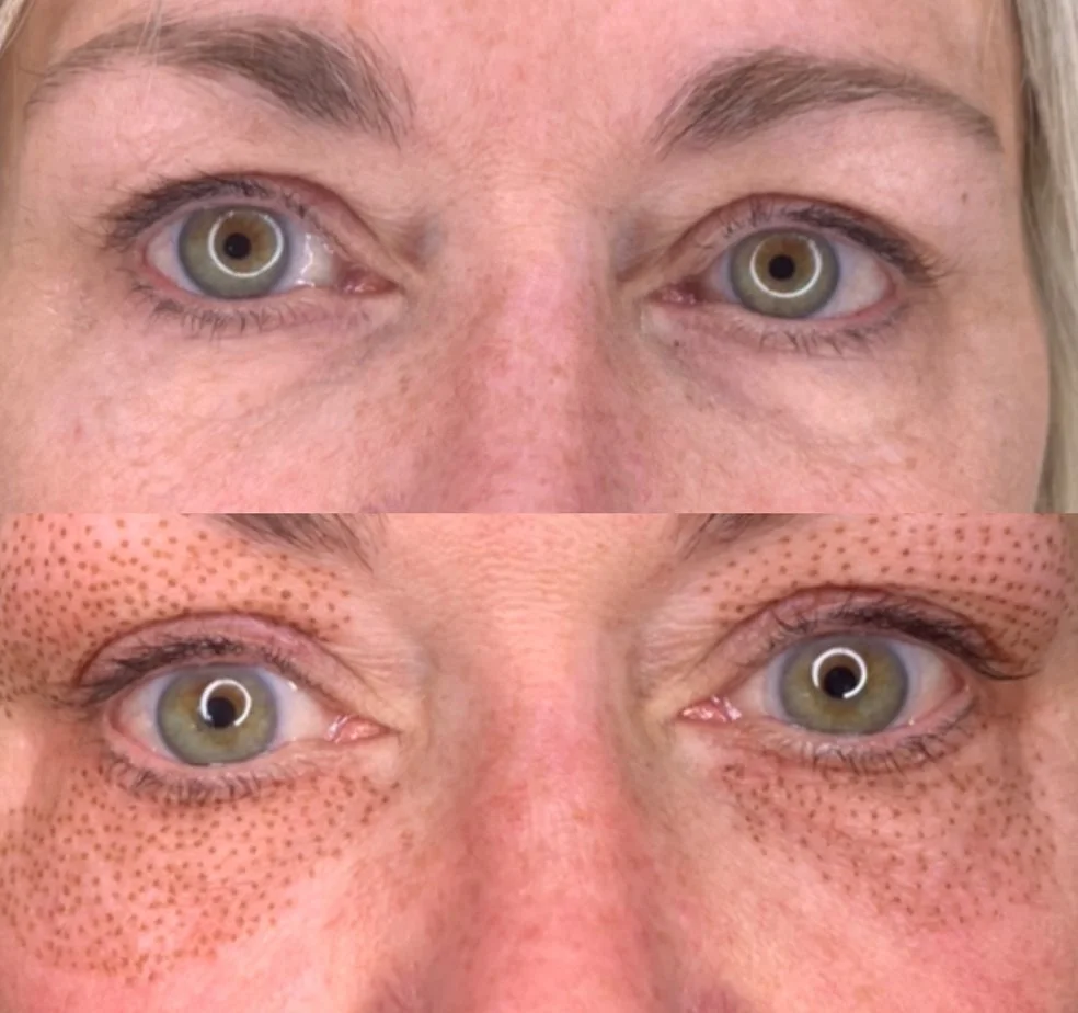 Before and after fibroblast treatment