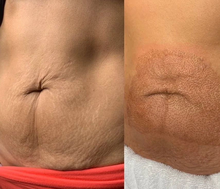 Before and After fibroblast treatment