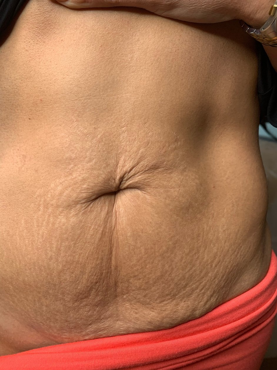 Before fibroblast treatment