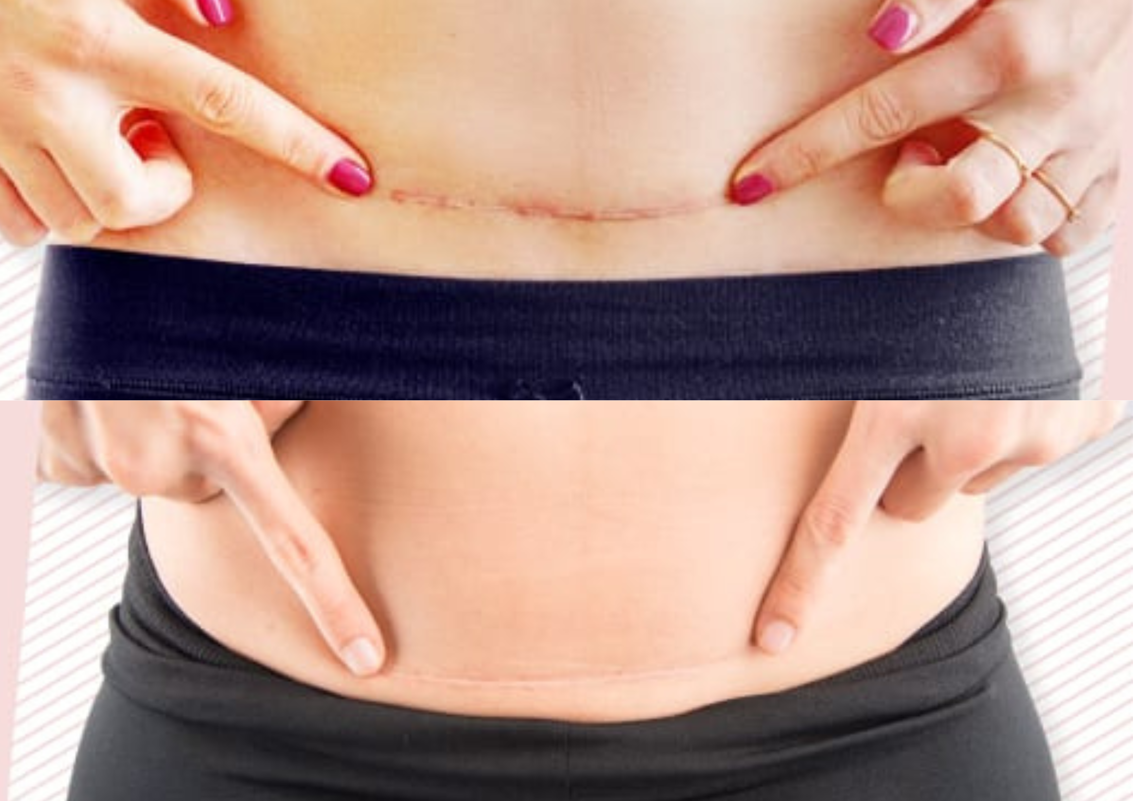 Caesarean Scar