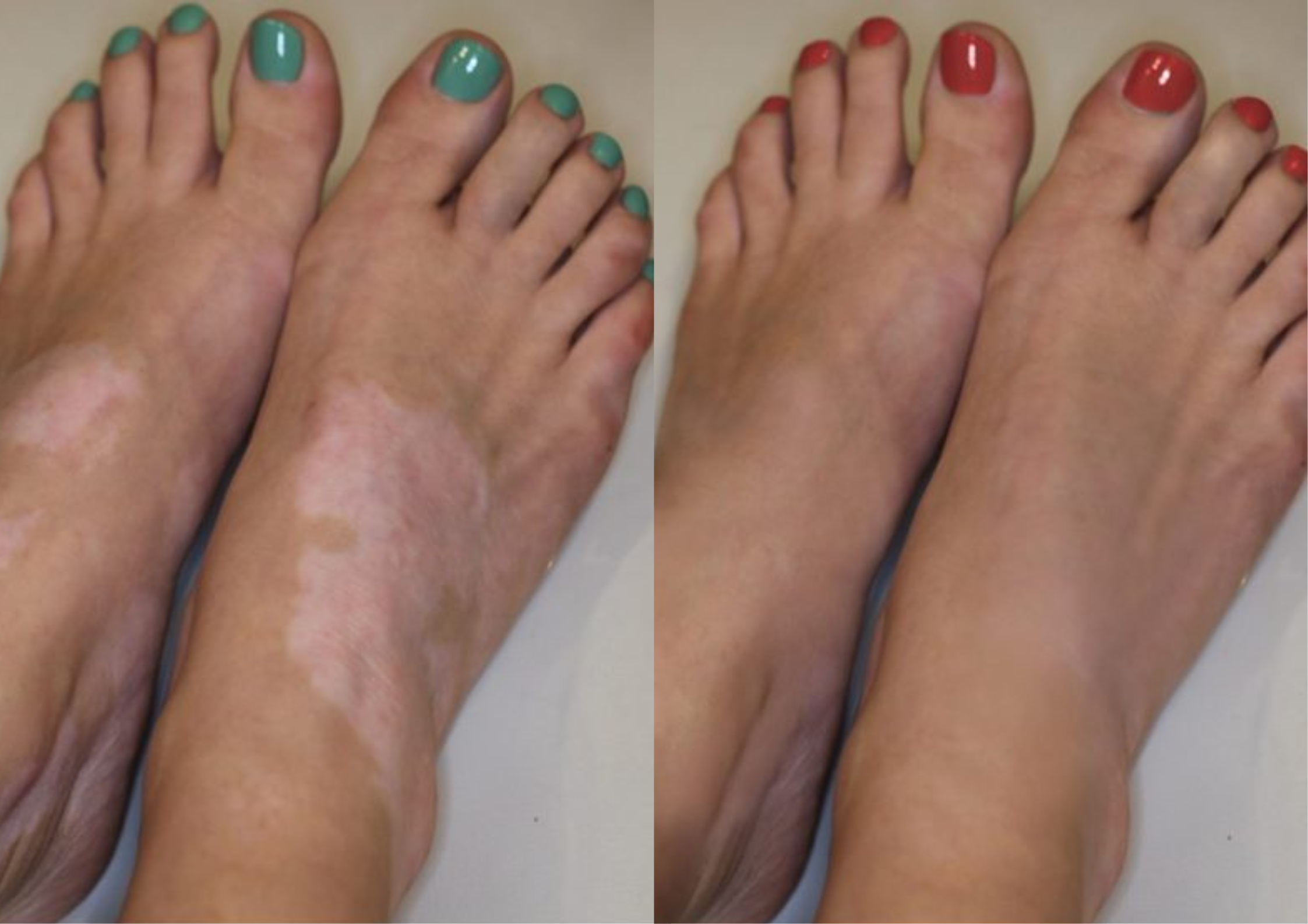 Vitiligo Camouflage