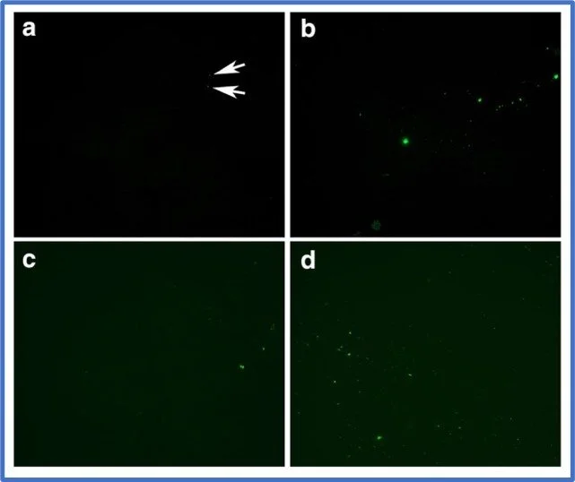 Microstolsel in Long COVID