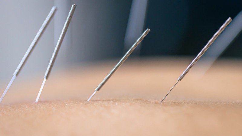 Dry Needling for Pelvic Floor Pain: Benefits &amp; How it Works