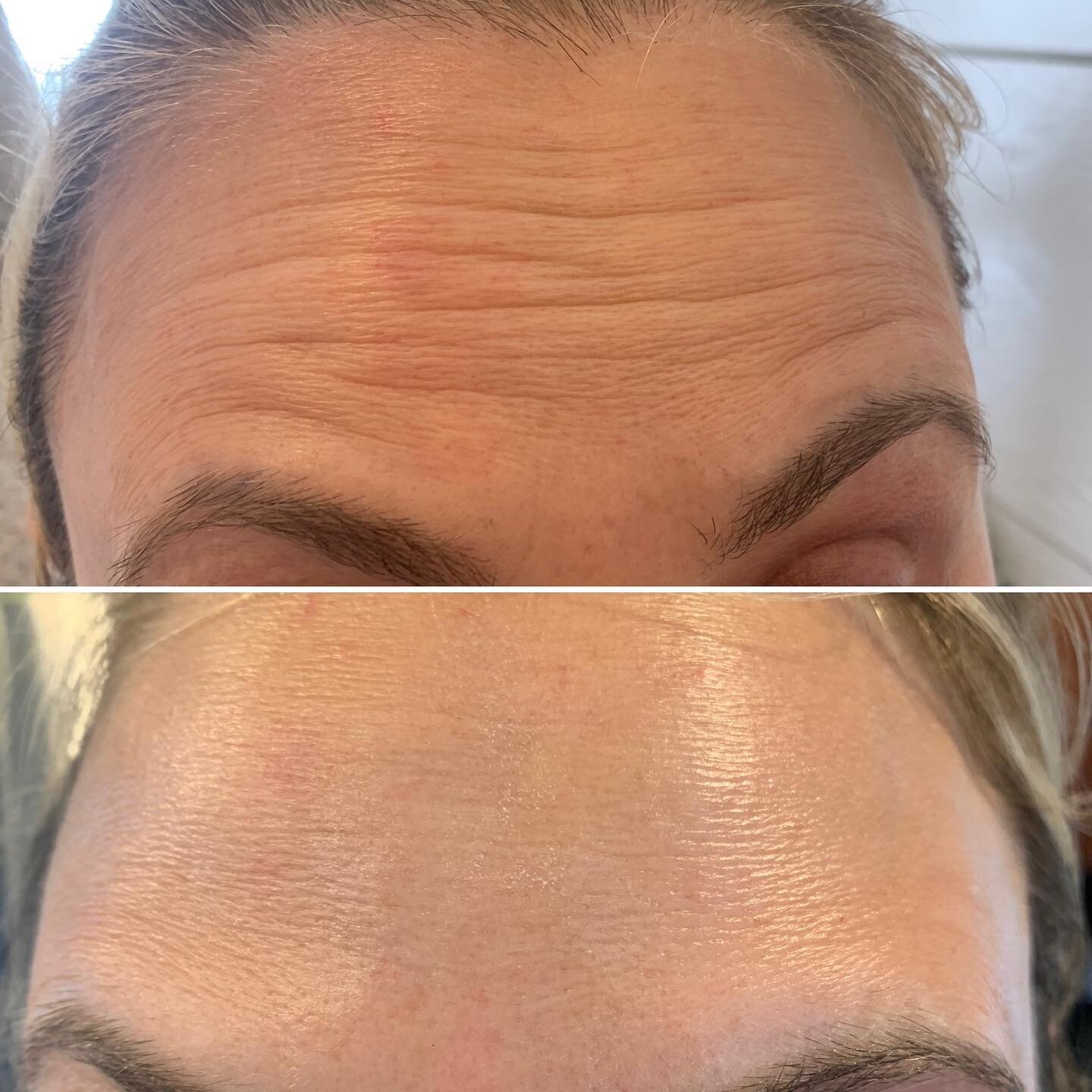 Before and two weeks after her Botox treatment. Both pictures taken in animation. #watervillemaine #botoxbeforeandafter #aesthetics #lookof3