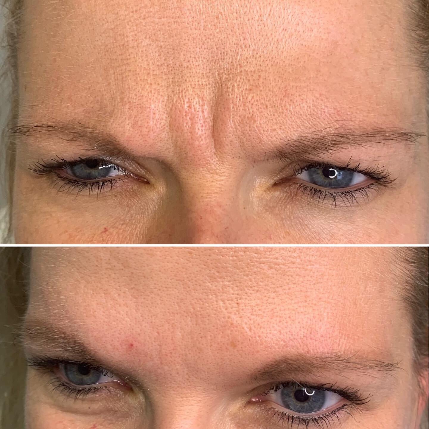 Microneedling with PRF will help improve texture, fine lines, firmness, discoloration and diminish pore size since it increases collagen and skin elasticity.  Adding a bit of Botox will help prevent any etched in lines long term.  #botox #watervillem