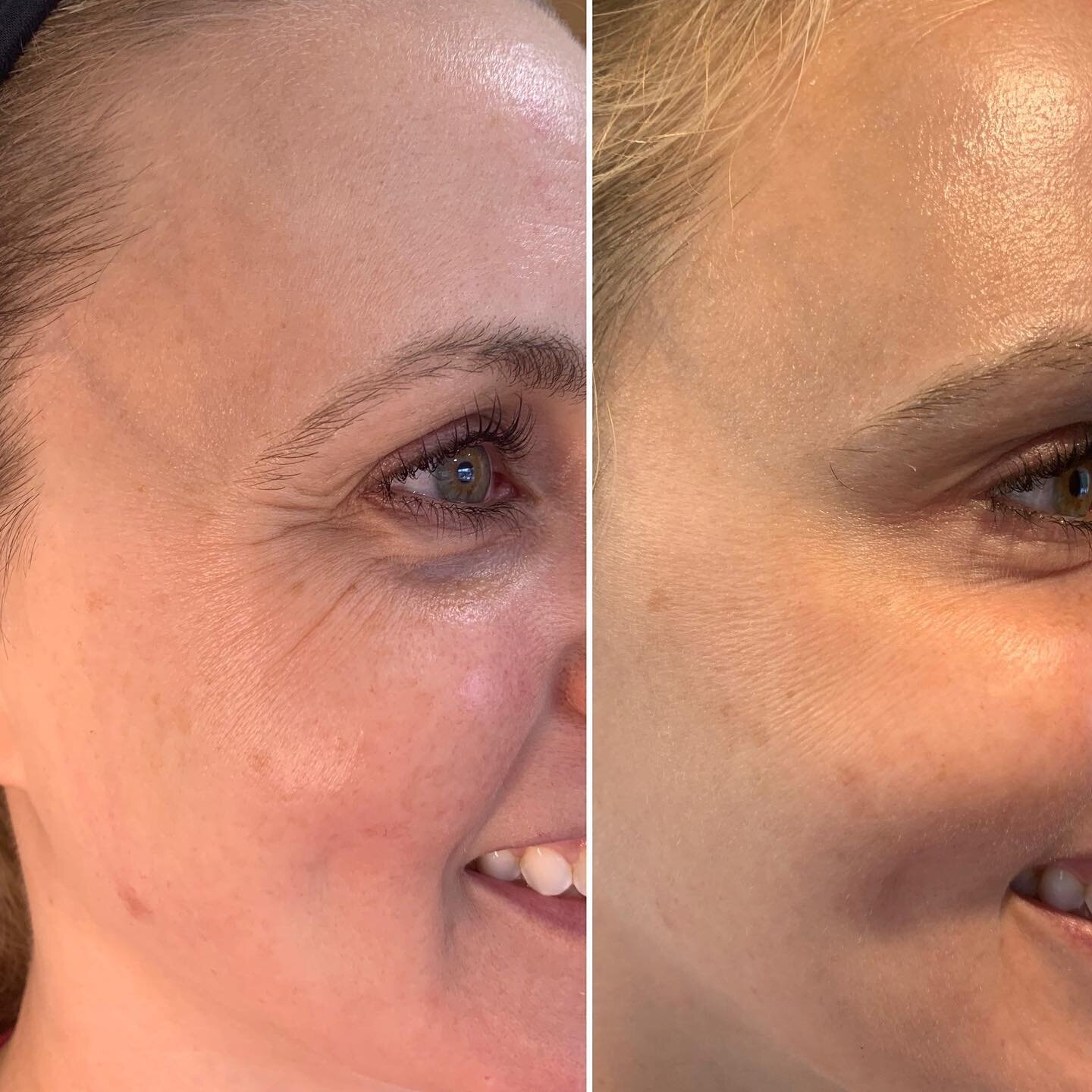 Aging is a fact but looking your age is not. ~Botox was used in this client to help soften the lines around her eyes. ~Two sessions of Miconeedling with PRF has helped tighten her skin, minimize dark circles, and help with hyperpigmentation. ~As we a