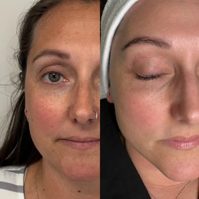 before and after light and bright photo showing reduced brown spots