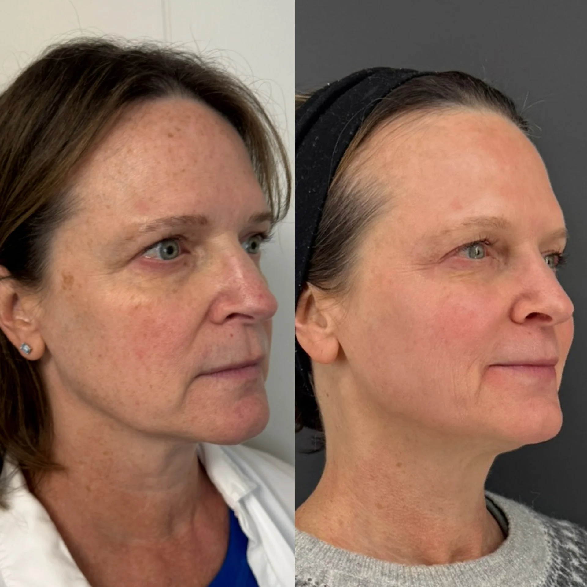 before and after of light and bright laser treatment