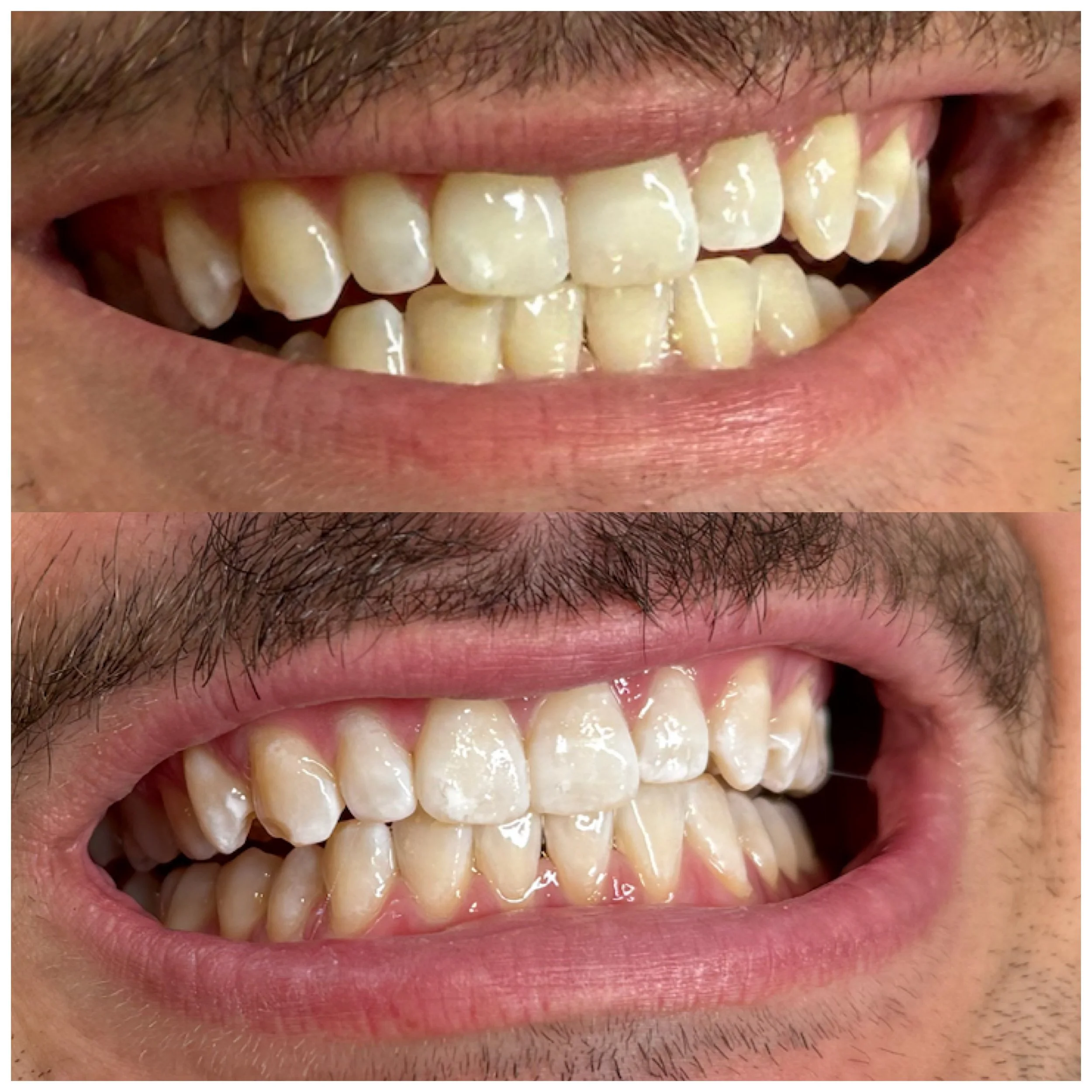 before and after teeth whitening photo of smiling man with slight mustache