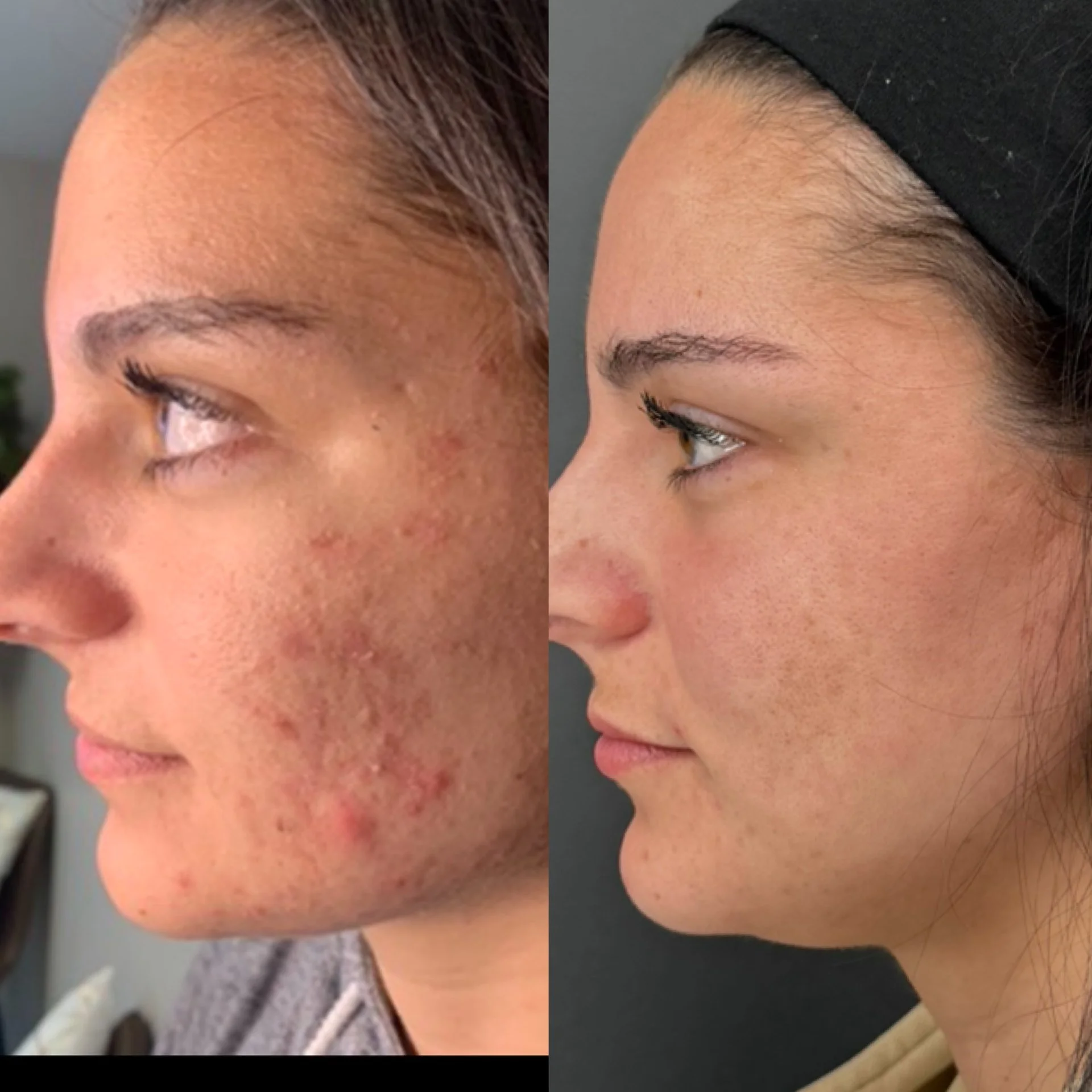 before and after showing clear skin with no to minimal acne