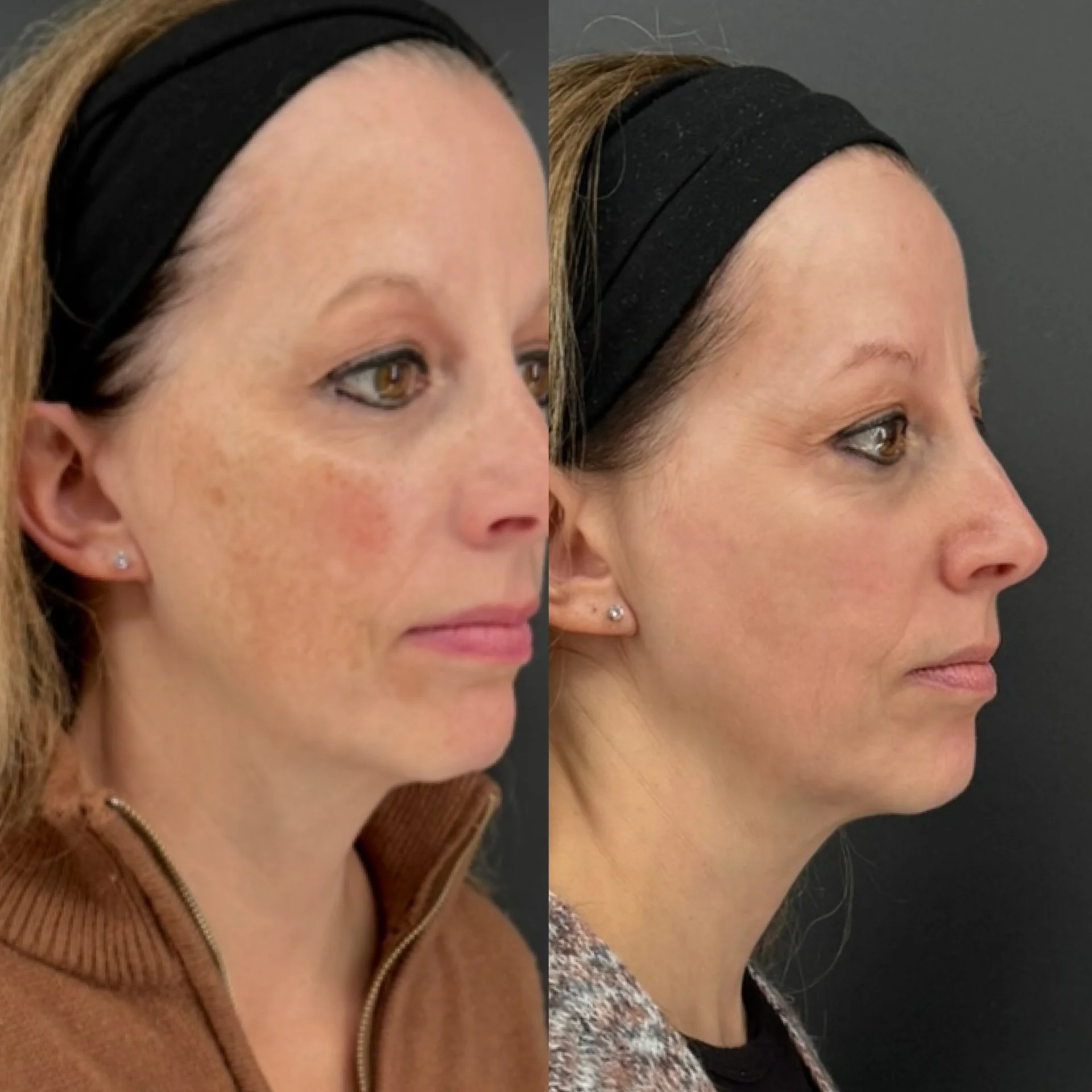before and after melasma treatment showing more even skin tone