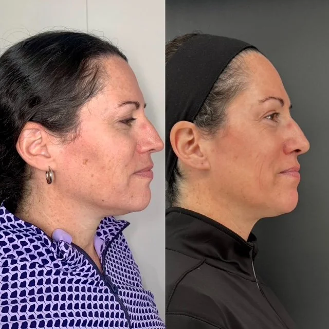 before and after photo showing more youthful looking skin