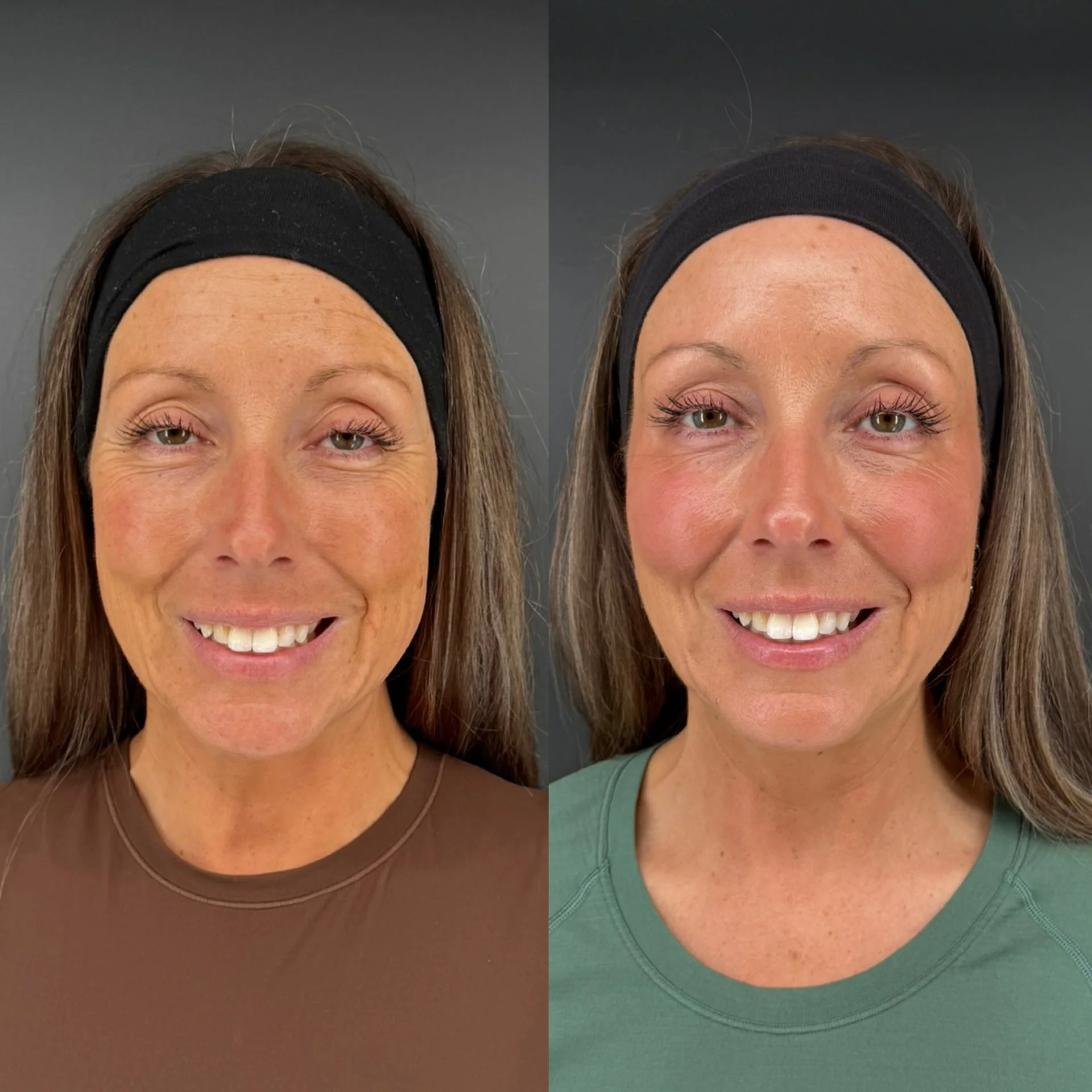 facial balancing with dermal filler