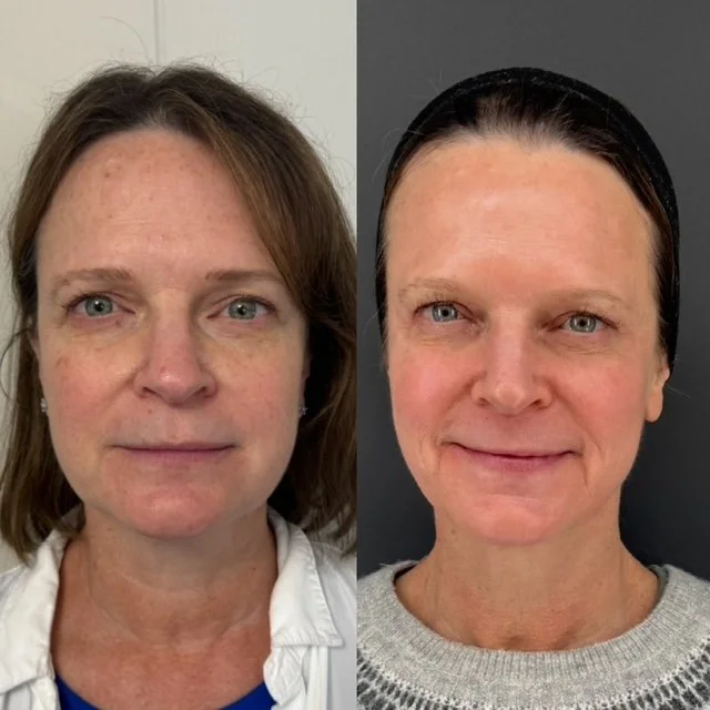 before and after light and bright and frax treament