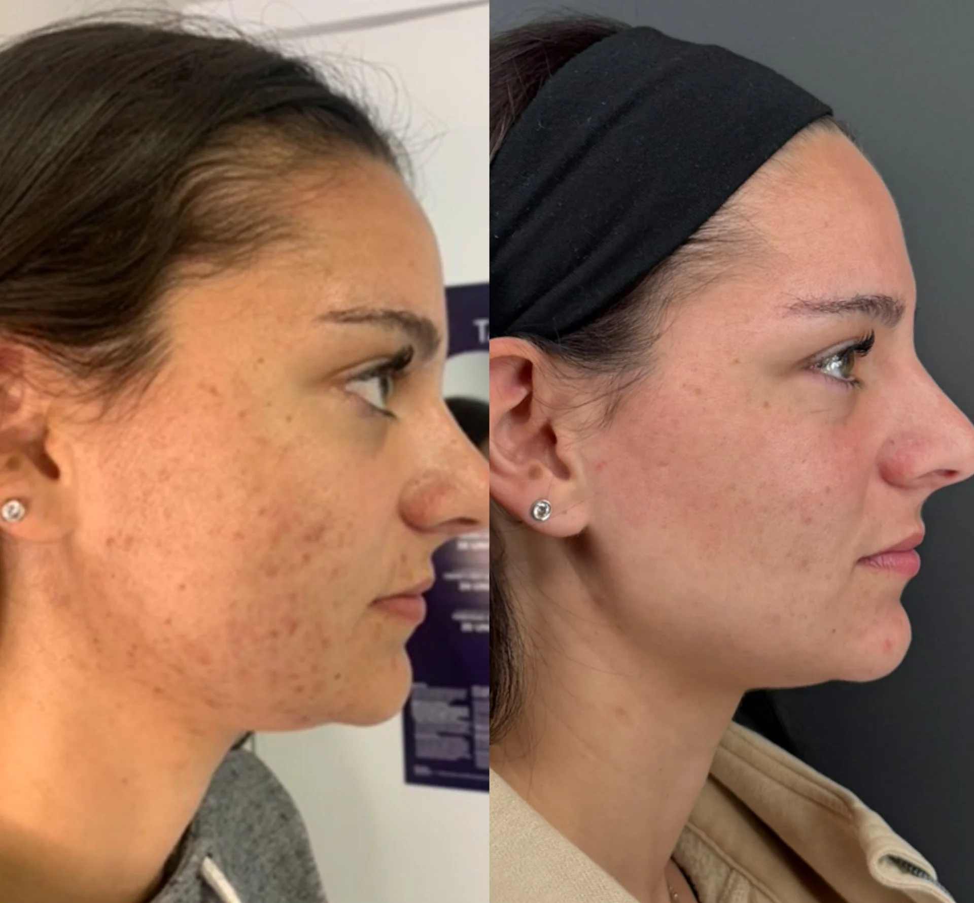 before and after light and bright treatment showing acne improvement and clarity for clear skin