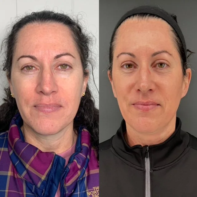 before and after photo after laser treatment for brighter, more even, younger looking skin