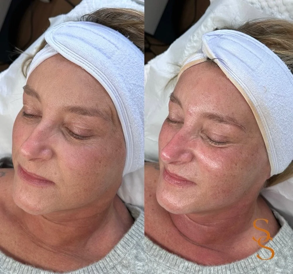 Sometimes results can be instant, 60 minutes later and this lovely client is looking more plump & hydrated by our Signature Facialπ§ 
The pigment on the headband is DermaQuests gorgeous tinted SPF which protects your skin whilst giving slight co